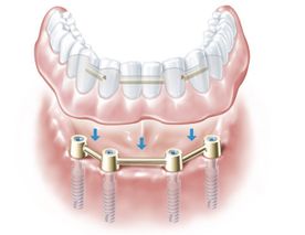 Abbildung Implantat im ganzen Unterkiefer