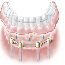 Abbildung Implantat im ganzen Unterkiefer