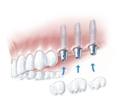 Abbildung von Oberkiefer und drei Backenzahn Implantat 