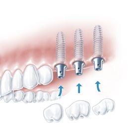 Abbildung von Oberkiefer und drei Backenzahn Implantat 