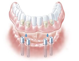 Abbildung eines kompletten Unterkiefer Implantats