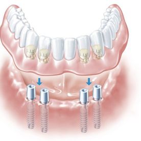 Abbildung eines kompletten Unterkiefer Implantats