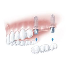 Abbildung von Oberkiefer und drei Backenzahn Brücken Implantat 