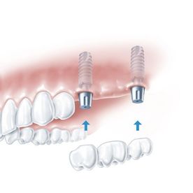 Abbildung von Oberkiefer und drei Backenzahn Brücken Implantat 