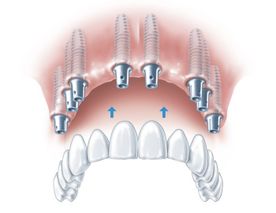 Abbildung von einem kompletten Oberkiefer Implantat
