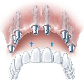 Abbildung von einem kompletten Oberkiefer Implantat
