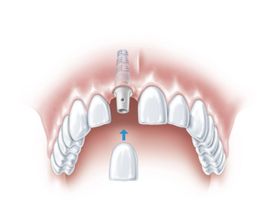 Abbildung eines Oberkiefer-Gebisses mit Schneidezahn Implantat und wie es auf den Zahn gesetzt wird
