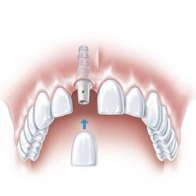 Abbildung eines Oberkiefer-Gebisses mit Schneidezahn Implantat und wie es auf den Zahn gesetzt wird